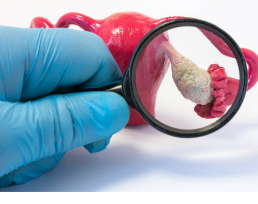 وبینار تنبلی تخمدان (PCOS) دوره 8 مهر