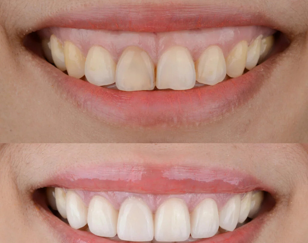 وبینار رایگان درمان لبخند لثه ای با تزریق فیلر و بوتاکس